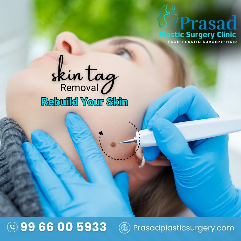 Skin Tag Removal Treatment in Visakhapatnam in  listed under Services - Doctors